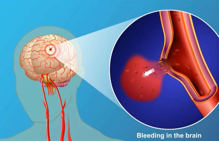 Nhật Bản bào chế được Vaccine ngừa đột quỵ